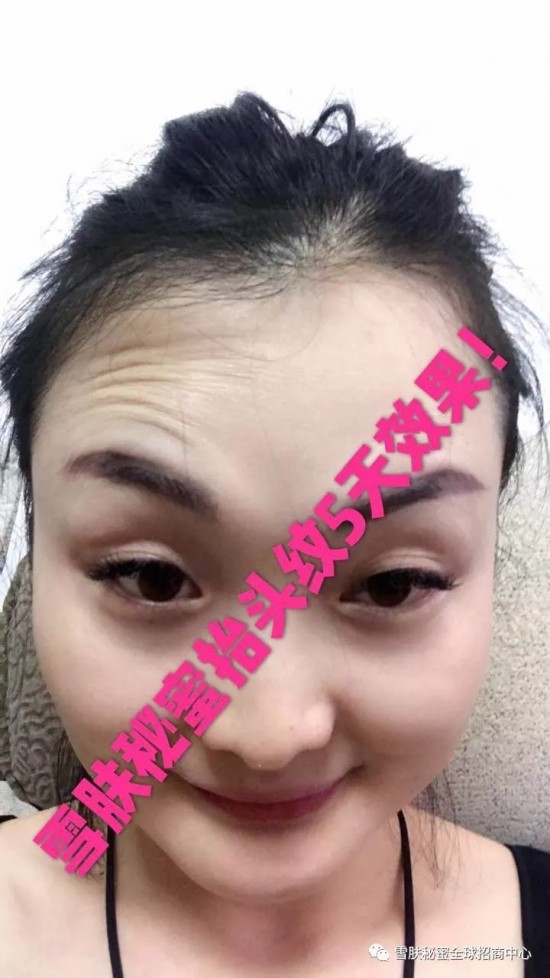 去皱纹有什么好方法?雪肤秘密无针祛皱效果能