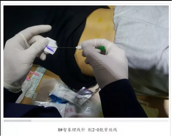 埋线减肥穴位与手法 ca514ba042014d0c570eefe5606d8054.png
