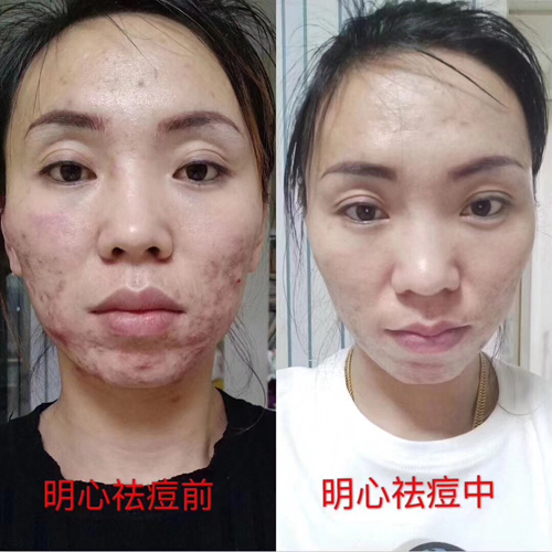 李氏明心祛痘膏 李氏明心祛痘膏好使吗?谁用过李氏明心祛痘膏?