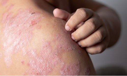 过敏性湿疹总反复，如何解决？益生菌真的有用吗？